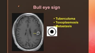 z
Bull eye sign
• Tuberculoma
• Toxoplasmosis
• Metastasis
 
