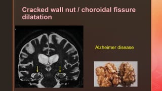 zCracked wall nut / choroidal fissure
dilatation
Alzheimer disease
 