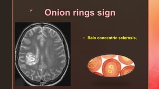 z
Onion rings sign
 Balo concentric sclerosis.
 