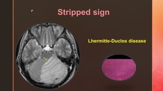 z
Stripped sign
Lhermitte-Duclos disease
 