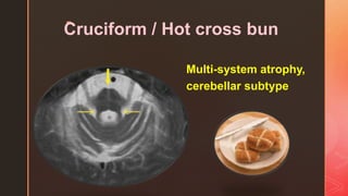 z
Cruciform / Hot cross bun
Multi-system atrophy,
cerebellar subtype
 