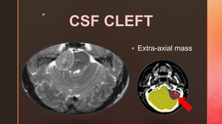z
CSF CLEFT
 Extra-axial mass
 