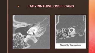 z LABYRINTHINE OSSIFICANS
 