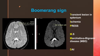 z
Boomerang sign
Transient lesion in
splenium
Ischemia
PRESS
M.S
Marchiafava-Bignami
disease (MBD)
DAI
 