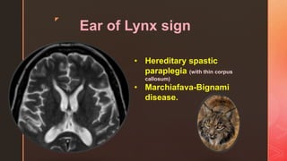 z
Ear of Lynx sign
• Hereditary spastic
paraplegia (with thin corpus
callosum)
• Marchiafava-Bignami
disease.
 