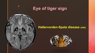 z
Eye of tiger sign
Hallervorden-Spatz disease (HSD)
 