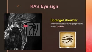 z
RA’s Eye sign
Sprengel shoulder
(Omovertebral band with peripheral fat
tissue) (Arrow).
 