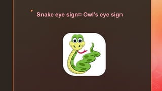 z
Snake eye sign= Owl’s eye sign
 