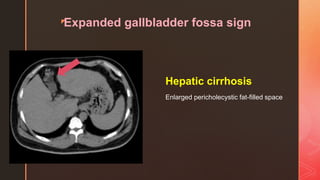 zExpanded gallbladder fossa sign
Hepatic cirrhosis
Enlarged pericholecystic fat-filled space
 