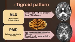 z Tigroid pattern
• Spares subcortical U fibers.
• Low T2 thalamus.MLD
Metachromatic
leukodystrophy
• Early involvement of the subcortical
U fibers.
• Typically involve posterior limb of
internal capsule.
PMD
Pelizaeus merzbacher
disease .
 