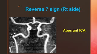 z
Reverse 7 sign (Rt side)
Aberrant ICA
 
