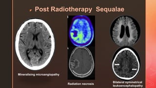 z Post Radiotherapy Sequalae
Mineralising microangiopathy
Bilateral symmetrical
leukoencephalopathy
Radiation necrosis
 