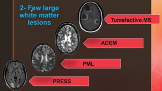 z
2- Few large
white matter
lesions Tumefactive MS
ADEM
PML
PRESS
 
