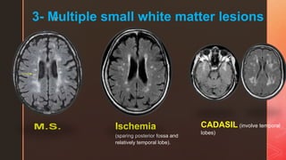 z3- Multiple small white matter lesions
Ischemia
(sparing posterior fossa and
relatively temporal lobe).
CADASIL (involve temporal
lobes)
 