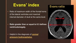 zEvans' index
 Ratio of maximum width of the frontal horns
of the lateral ventricles and maximal
internal diameter of skull at the same level.
 Ratio greater than or equal to 0.3 defines
ventriculomegaly.
 Helpful in the diagnosis of normal
pressure hydrocephalus.
 