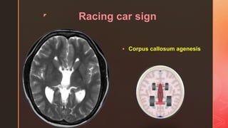 z
Racing car sign
 Corpus callosum agenesis
 