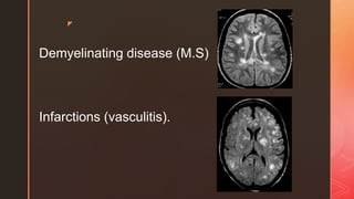 z
Demyelinating disease (M.S)
Infarctions (vasculitis).
 