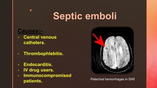 z
Causes:-
- Central venous
catheters.
- Thrombophlebitis.
- Endocarditis.
- IV drug users.
- Immunocompromised
patients. Petechial hemorrhages in SWI
Septic emboli
 