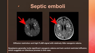 z
Septic emboli
Diffusion restriction and high FLAIR signal with relatively little vasogenic edema.
Neoplasms generally incite significant vasogenic edema and lack central restricted diffusion,
which suggests an infectious process in this case.
 