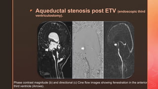 z Aqueductal stenosis post ETV (endoscopic third
ventriculostomy).
Phase contrast magnitude (b) and directional (c) Cine flow images showing fenestration in the anterior
third ventricle (Arrows).
 