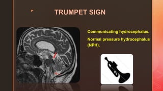 z
TRUMPET SIGN
Communicating hydrocephalus.
Normal pressure hydrocephalus
(NPH).
 