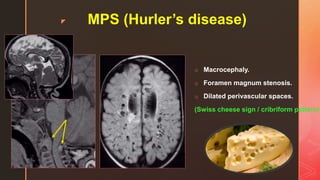 z MPS (Hurler’s disease)
o Macrocephaly.
o Foramen magnum stenosis.
o Dilated perivascular spaces.
(Swiss cheese sign / cribriform pattern)
 