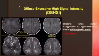 z
Diffuse Excessive High Signal Intensity
(DEHSI)
Bilateral white matter
exaggerated T2 hyperintensities
due to mild hypoxic event.
’’ Red areas’’
 
