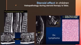 z
Steroid effect in children
histopathology during steroid therapy is false.
 