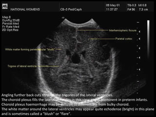 Angling further back cuts through the trigones of the lateral ventricles.
The choroid plexus fills the lateral ventricles in this view and is prominent in preterm infants.
Choroid plexus haemorrhage may be difficult to differentiate from bulky choroid.
The white matter around the lateral ventricles may appear quite echodense (bright) in this plane
and is sometimes called a "blush" or "flare".
 