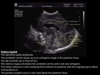 Midline Sagittal
This identifies useful landmarks.
The cerebellar vermis shows up as an echogenic image in the posterior fossa.
The 4th ventricle sits in front of this.
The cisterna magna sits below the cerebellar vermis and is not very echogenic.
The corpus callosum is seen sweeping from anterior to posterior with the cingulate gyrus above
and parallel to it.
The parieto-occipital sulcus is seen well above the posterior fossa.
 