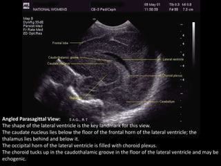 Angled Parasagittal View:
The shape of the lateral ventricle is the key landmark for this view.
The caudate nucleus lies below the floor of the frontal horn of the lateral ventricle; the
thalamus lies behind and below it.
The occipital horn of the lateral ventricle is filled with choroid plexus.
The choroid tucks up in the caudothalamic groove in the floor of the lateral ventricle and may be
echogenic.
 