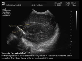 Tangential Parasagittal View:
Further angulation of the transducer laterally results in a section lateral to the lateral
ventricles. The Sylvian fissure is the key landmark in this view.
 