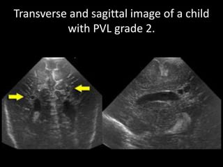 Transverse and sagittal image of a child
with PVL grade 2.
 