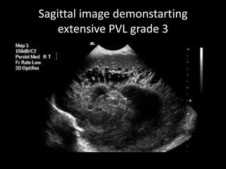 Sagittal image demonstarting
extensive PVL grade 3
 