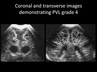 Coronal and transverse images
demonstrating PVL grade 4
 