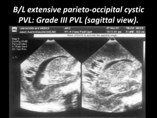 B/L extensive parieto-occipital cystic
PVL: Grade III PVL (sagittal view).
 