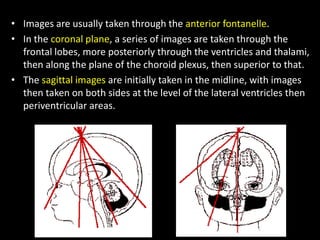 • Images are usually taken through the anterior fontanelle.
• In the coronal plane, a series of images are taken through the
frontal lobes, more posteriorly through the ventricles and thalami,
then along the plane of the choroid plexus, then superior to that.
• The sagittal images are initially taken in the midline, with images
then taken on both sides at the level of the lateral ventricles then
periventricular areas.
 