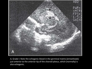 A, Grade I: Note the echogenic blood in the germinal matrix (arrowheads)
just anterior to the anterior tip of the choroid plexus, which (normally) is
also echogenic.
 