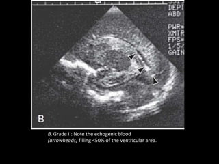 B, Grade II: Note the echogenic blood
(arrowheads) filling <50% of the ventricular area.
 