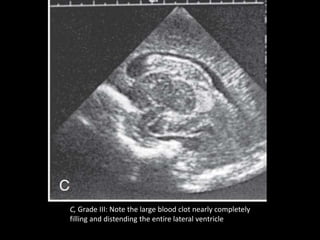 C, Grade III: Note the large blood clot nearly completely
filling and distending the entire lateral ventricle
 