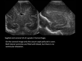 Sagittal and coronal US of a grade 2 hemorrhage;
On the coronal image only the cavum septi pellucidi is seen.
Both lateral ventricles are filled with blood, but there is no
ventricular dilatation.
 