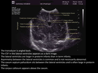 The transducer is angled back.
The CSF in the lateral ventricles appears as a dark image.
The lateral ventricles are larger in preterm infants than in term infants.
Asymmetry between the lateral ventricles is common and is not necessarily abnormal.
The cavum septum pallucidum sits between the lateral ventricles and is often large in preterm
infants.
The corpus callosum appears above the cavum.
 