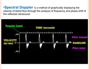 •Spectral Doppler is a method of graphically displaying the
velocity of blood flow through the analysis of frequency and phase shift of
the reflected ultrasound
 