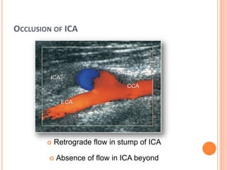 OCCLUSION OF ICA
 Retrograde flow in stump of ICA
 Absence of flow in ICA beyond
ICA
ECA
CCA
 