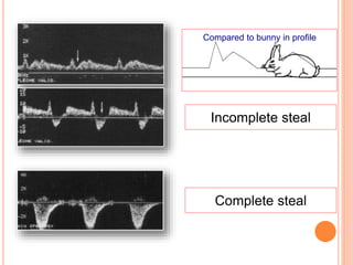 VERTEBRAL TO SUBCLAVIAN STEAL
Presteal
Incomplete steal
Complete steal
Compared to bunny in profile
 
