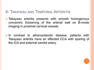 6- TAKAYASU AND TEMPORAL ARTERITIS
 Takayasu arteritis presents with smooth homogenous
concentric thickening of the arterial wall on B-mode
imaging in proximal cervical vessels
 In contrast to atherosclerotic disease, patients with
Takayasu arteritis have an affected CCA with sparing of
the ICA and external carotid artery.
 