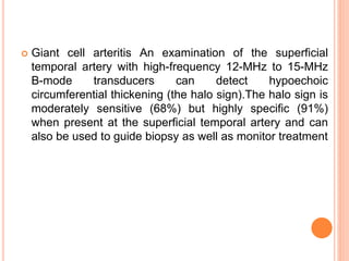  Giant cell arteritis An examination of the superficial
temporal artery with high-frequency 12-MHz to 15-MHz
B-mode transducers can detect hypoechoic
circumferential thickening (the halo sign).The halo sign is
moderately sensitive (68%) but highly specific (91%)
when present at the superficial temporal artery and can
also be used to guide biopsy as well as monitor treatment
 