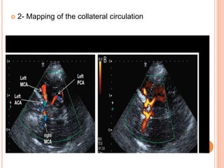  2- Mapping of the collateral circulation
 