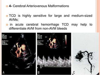  4- Cerebral Arteriovenous Malformations
 TCD is highly sensitive for large and medium-sized
AVMs;
 in acute cerebral hemorrhage TCD may help to
differentiate AVM from non-AVM bleeds
 