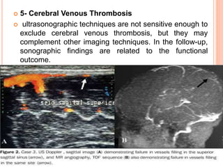  5- Cerebral Venous Thrombosis
 ultrasonographic techniques are not sensitive enough to
exclude cerebral venous thrombosis, but they may
complement other imaging techniques. In the follow-up,
sonographic findings are related to the functional
outcome.
 